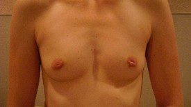 Breast Augmentation Patient Photo - Case 913 - before view-