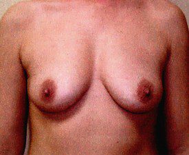 Breast Augmentation Patient Photo - Case 870 - before view-