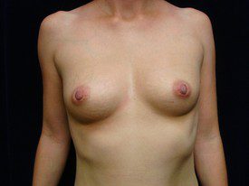 Breast Augmentation Patient Photo - Case 956 - before view-