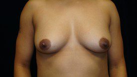 Breast Augmentation Patient Photo - Case 903 - before view-