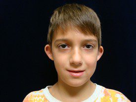 Ear Surgery Patient Photo - Case 1081 - before view-