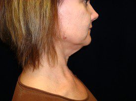 Neck Liposuction Patient Photo - Case 1162 - before view-