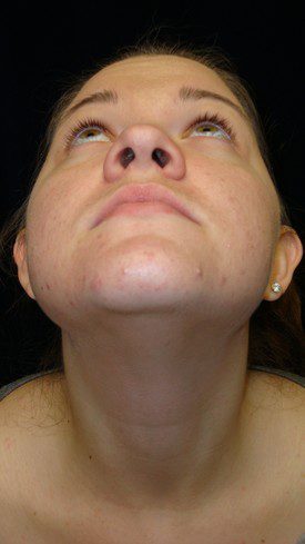 Nose Surgery Patient Photo - Case 1172 - before view-1