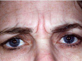 Botox Treatments Patient Photo - Case 994 - before view-