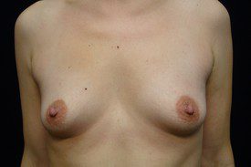 Breast Augmentation - Case 1015 - Before