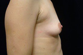 Breast Augmentation Patient Photo - Case 1015 - before view-1