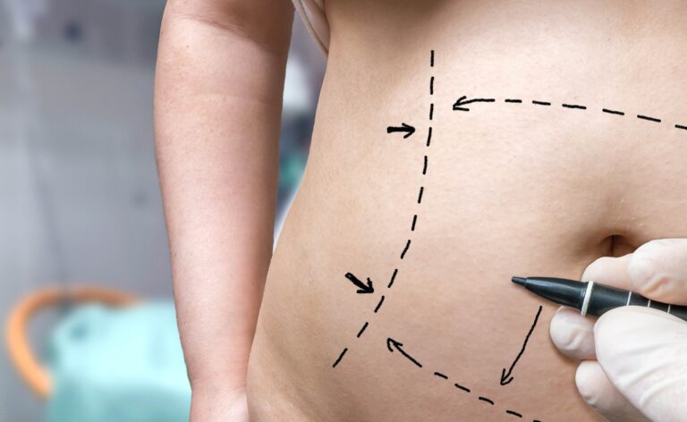 3 Questions to Ask Yourself Before Having a Tummy Tuck